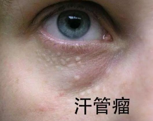 两个月宝宝长脂肪粒，成因、护理与预防