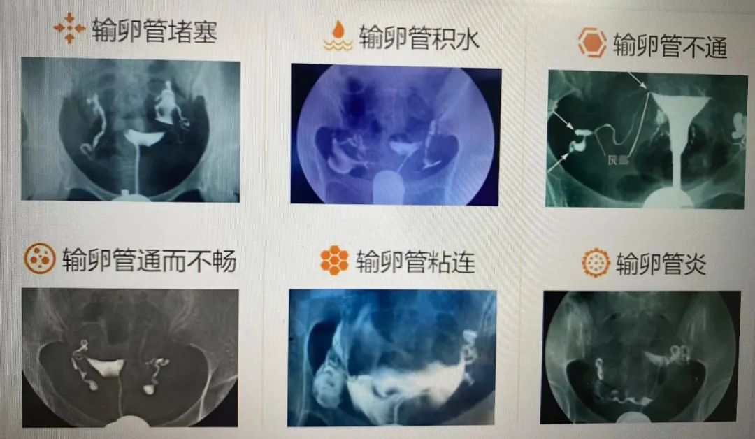 灌肠与输卵管通畅性，深度解析及专业探讨